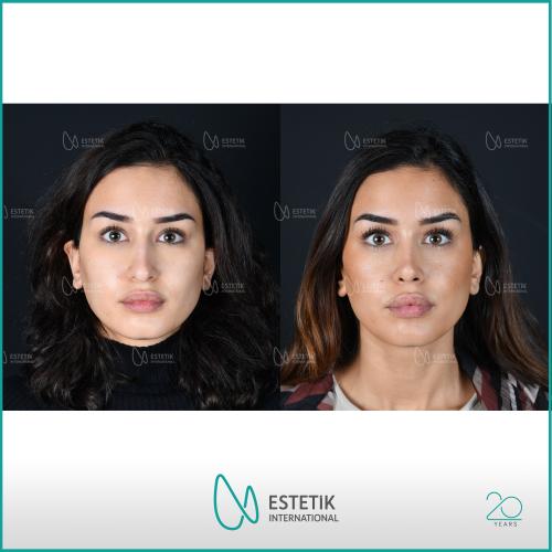 جراحة رأب الذقن صور قبل وبعد